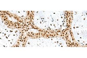 Immunohistochemistry of paraffin-embedded Human breast cancer tissue using PRPF40A Polyclonal Antibody at dilution of 1:60(x200) (PRPF40A 抗体)