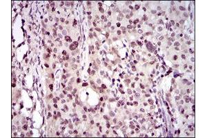 Immunohistochemical analysis of paraffin-embedded cervical cancer tissues using PCNA mouse mAb with DAB staining. (PCNA 抗体  (AA 53-196))