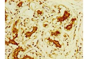 IHC image of ABIN7149989 diluted at 1:800 and staining in paraffin-embedded human breast cancer performed on a Leica BondTM system. (DPP9 抗体  (AA 289-437))