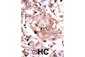 Formalin-fixed and paraffin-embedded human cancer tissue reacted with the primary antibody, which was peroxidase-conjugated to the secondary antibody, followed by AEC staining. (PPP2CA 抗体  (C-Term))