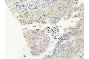 ABIN6259919 and ABIN6269342 at 1/100 staining human cervical carcinoma by IHC-P. (PRKAA1 抗体  (C-Term))