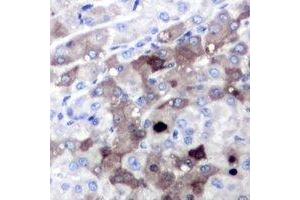 Immunohistochemical analysis of SGTA staining in human liver cancer formalin fixed paraffin embedded tissue section. (SGTA 抗体)