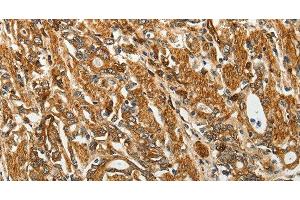 Immunohistochemistry of paraffin-embedded Human gastic cancer using RPLP0 Polyclonal Antibody at dilution of 1:40 (RPLP0 抗体)