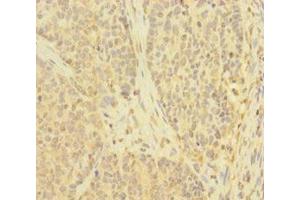 Immunohistochemistry of paraffin-embedded human ovarian cancer using ABIN7173908 at dilution of 1:100 (TNFAIP6 抗体  (AA 18-277))