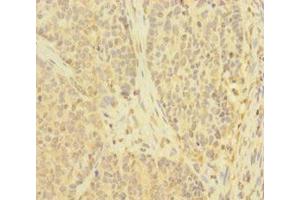 Immunohistochemistry of paraffin-embedded human ovarian cancer using ABIN7173908 at dilution of 1:100