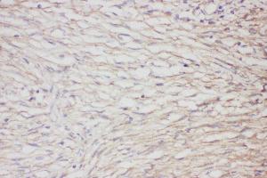 Anti-GFAP Picoband antibody,  IHC(P): Human meningioma Tissue (GFAP 抗体  (AA 93-432))