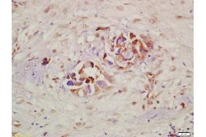 Formalin-fixed and paraffin embedded human lung carcinoma labeled with Rabbit Anti-c-Kit(Tyr721) Polyclonal Antibody, Unconjugated  at 1:200 followed by conjugation to the secondary antibody and DAB staining (KIT 抗体  (pTyr721))