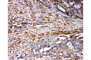 Anti-VRL1 antibody, IHC(P) IHC(P): Human Mammary Cancer Tissue (TRPV2 抗体  (N-Term))