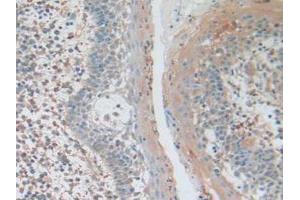 IHC-P analysis of Human Skin Cancer Tissue, with DAB staining. (AKT3 抗体  (AA 46-338))