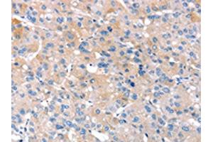 The image on the left is immunohistochemistry of paraffin-embedded Human liver cancer tissue using ABIN7130903(RNF214 Antibody) at dilution 1/20, on the right is treated with fusion protein. (RNF214 抗体)