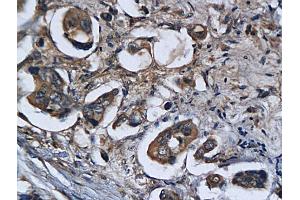 Formalin-fixed and paraffin embedded human colorectal cancer labeled with Anti Legumain Polyclonal Antibody, Unconjugated (ABIN750958) followed by conjugation to the secondary antibody and DAB staining (LGMN 抗体  (AA 201-300))