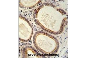 TR antibody (C-term) (ABIN652176 and ABIN2840578) immunohistochemistry analysis in formalin fixed and paraffin embedded human prostate carcinoma followed by peroxidase conjugation of the secondary antibody and DAB staining. (TRAM2 抗体  (C-Term))