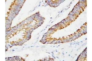 IHC-P: BCAT2 antibody testing of human colon cancer tissue (BCAT2 抗体  (C-Term))