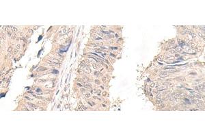 Immunohistochemistry of paraffin-embedded Human lung cancer tissue using OLA1 Polyclonal Antibody at dilution of 1:45(x200) (OLA1 抗体)
