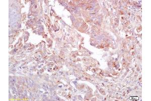 Formalin-fixed and paraffin embedded human lung carcinoma labeled with Anti-GnRHR Polyclonal Antibody, Unconjugated  at 1:200 followed by conjugation to the secondary antibody and DAB staining (FAK 抗体  (pTyr397))