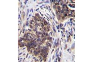 Immunohistochemistry analysis in formalin fixed and paraffin embedded human lung carcinoma reacted with Alpha-glucosidase Antibody (N-term) followed by peroxidase conjugation of the secondary antibody and DAB staining. (AGLU 抗体  (N-Term))
