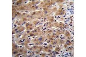 Glypican 3 antibody immunohistochemistry analysis in formalin fixed and paraffin embedded human liver tissue. (Glypican 3 抗体  (AA 21-50))