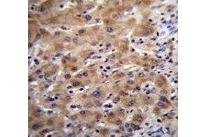 Glypican 3 antibody immunohistochemistry analysis in formalin fixed and paraffin embedded human liver tissue.