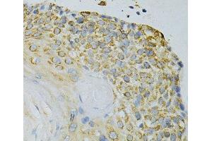 Immunohistochemistry of paraffin-embedded Human esophageal cancer using GPX4 Polyclonal Antibody at dilution of 1:200 (40x lens). (GPX4 抗体)