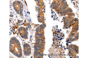 Immunohistochemistry of Human colon cancer using NCK1 Polyclonal Antibody at dilution of 1:30 (NCK1 抗体)