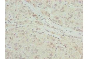 Immunohistochemistry of paraffin-embedded human liver cancer using ABIN7168087 at dilution of 1:100 (RIBC2 抗体  (AA 1-309))