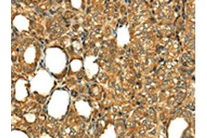 The image on the left is immunohistochemistry of paraffin-embedded Human thyroid cancer tissue using ABIN7130886(RLN1 Antibody) at dilution 1/20, on the right is treated with fusion protein. (Relaxin 1 抗体)