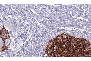ABIN6268911 at 1/100 staining Human urothelial cancer tissue by IHC-P. (Claudin 11 抗体  (C-Term))
