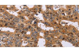 Immunohistochemistry of paraffin-embedded Human gasrtic cancer tissue using NIF3L1 Polyclonal Antibody at dilution 1:30 (NIF3L1 抗体)