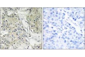 Immunohistochemistry analysis of paraffin-embedded human breast carcinoma tissue, using TM16J Antibody. (ANO9 抗体  (AA 481-530))