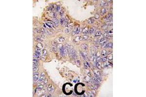Formalin-fixed and paraffin-embedded human colon carcinoma tissue reacted with TRAF2 polyclonal antibody  , which was peroxidase-conjugated to the secondary antibody, followed by DAB staining. (TRAF2 抗体  (C-Term))