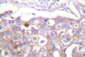 Immunohistochemical analysis of CLDN4 polyclonal antibody  in paraffin-embedded human breast carcinoma tissue.