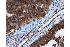Immunohistochemical staining of paraffin-embedded Adenocarcinoma of breast tissue using anti-TPMT mouse monoclonal antibody. (TPMT 抗体)