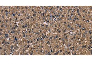 Immunohistochemistry of paraffin-embedded Human liver cancer tissue using FGF7 Polyclonal Antibody at dilution of 1:30 (FGF7 抗体)