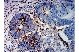 Immunohistochemical analysis of paraffin-embedded rectum cancer tissues using MUC16 mouse mAb with DAB staining. (MUC16 抗体  (AA 1-200))