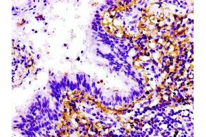 IHC image of ABIN7172220 diluted at 1:100 and staining in paraffin-embedded human lung cancer performed on a Leica BondTM system. (Titin 抗体  (AA 5398-5604))