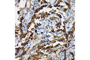 Immunohistochemistry of paraffin-embedded human lung cancer using SFTP Rabbit pAb (ABIN3017436, ABIN3017437, ABIN3017438 and ABIN6220091) at dilution of 1:50 (40x lens). (Surfactant Protein A1 抗体)