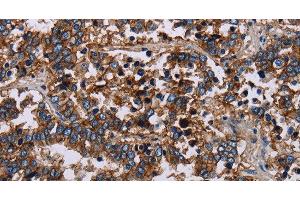 Immunohistochemistry of paraffin-embedded Human liver cancer using JAM-A Polyclonal Antibody at dilution of 1:40 (F11R 抗体)