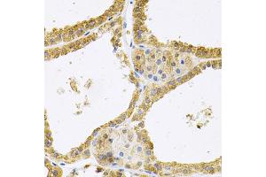 Immunohistochemistry of paraffin-embedded human thyroid cancer using FHL1 Antibody (ABIN1876648) at dilution of 1:100 (40x lens).
