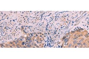 Immunohistochemistry of paraffin-embedded Human cervical cancer tissue using PPEF1 Polyclonal Antibody at dilution of 1:100(x200) (PPEF1 抗体)