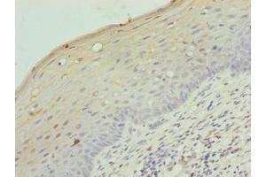 Immunohistochemistry of paraffin-embedded human cervical cancer using ABIN7158142 at dilution of 1:100 (LRRC18 抗体  (AA 1-261))