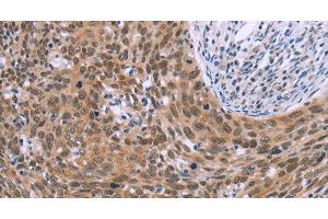 Immunohistochemistry of paraffin-embedded Human cervical cancer tissue using GLYR1 Polyclonal Antibody at dilution 1:30 (GLYR1 抗体)