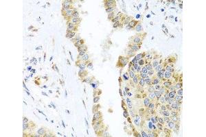 Immunohistochemistry of paraffin-embedded Human lung cancer using DARS2 Polyclonal Antibody at dilution of 1:100 (40x lens). (DARS2 抗体)