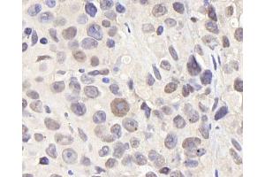 Immunohistochemistry analysis of paraffin-embedded Mouse breast cancer using CDC25A Polyclonal Antibody at dilution of 1:1000. (CDC25A 抗体)