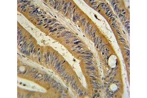 WNT10B antibody immunohistochemistry analysis in formalin fixed and paraffin embedded human colon carcinoma.