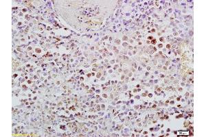 Formalin-fixed and paraffin embedded mouse lymphoma labeled with Anti-Phospho-NFKB p65(Ser276) Polyclonal Antibody, Unconjugated (ABIN700555) at 1:200, followed by conjugation to the secondary antibody and DAB staining (NF-kB p65 抗体  (pSer276))