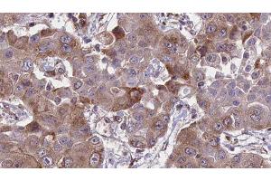 ABIN6276655 at 1/100 staining Human liver cancer tissue by IHC-P. (HFE 抗体  (Internal Region))