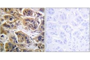 Immunohistochemistry analysis of paraffin-embedded human breast carcinoma tissue, using HER3 (Ab-1289) Antibody.