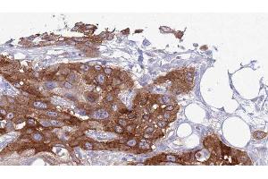 ABIN6277437 at 1/100 staining Human Head and neck cancer tissue by IHC-P. (TRAF7 抗体  (N-Term))