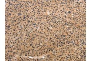 The image on the left is immunohistochemistry of paraffin-embedded Human liver cancer tissue using ABIN7189683(ADIPOR2 Antibody) at dilution 1/15, on the right is treated with synthetic peptide. (Adiponectin Receptor 2 抗体)
