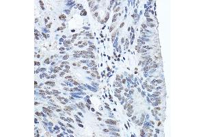 Immunohistochemistry of paraffin-embedded human colon carcinoma using Twist Rabbit pAb (ABIN6133951, ABIN6149713, ABIN6149716 and ABIN6220170) at dilution of 1:200 (40x lens). (TWIST1 抗体  (AA 1-100))